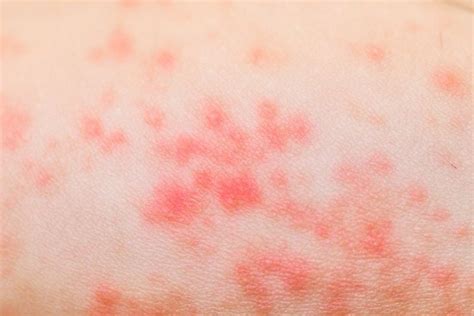 No particular racial, ethnic, or geographical preference is observed. . Sepsis rash pictures adults